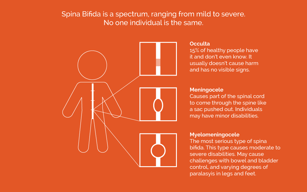 Spina Bifida is a spectrum